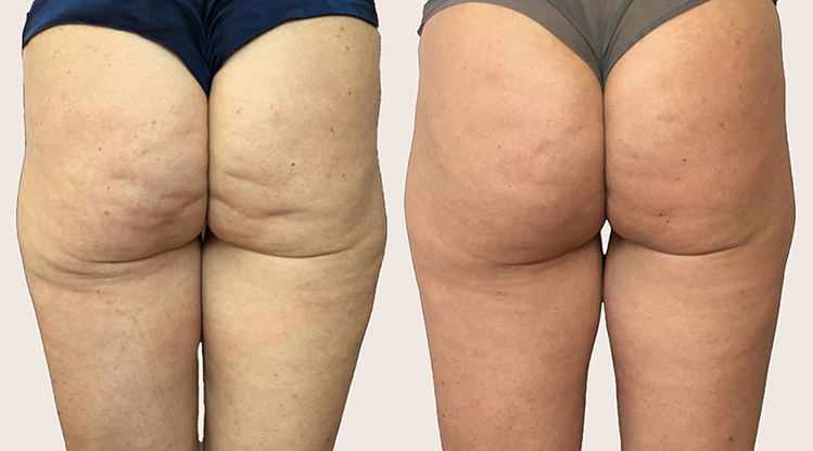 antes y despues Alidya Anticelulítico