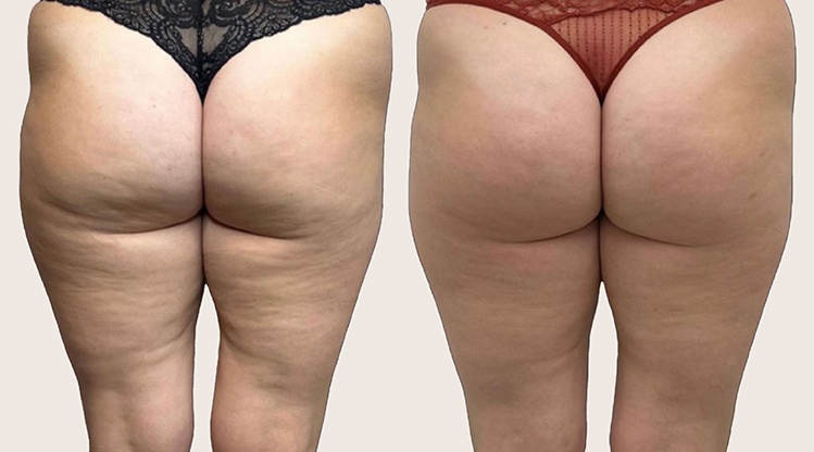 antes y despues Alidya Anticelulítico