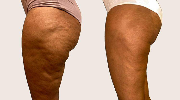 antes y despues Alidya Anticelulítico