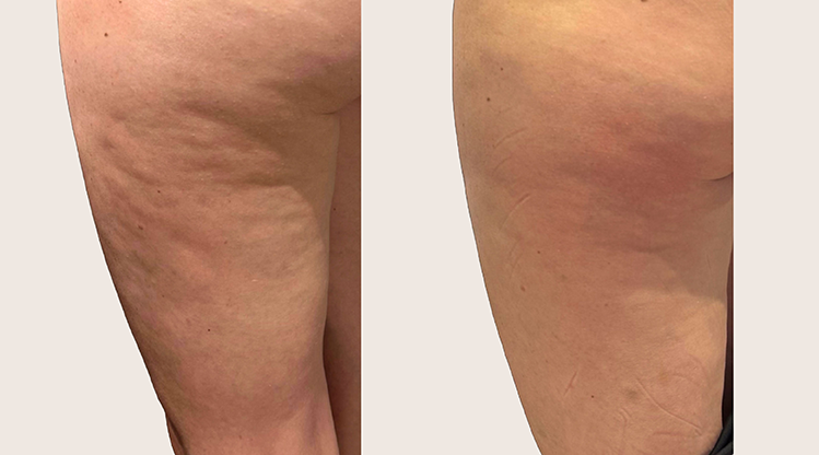 antes y despues Alidya Anticelulítico