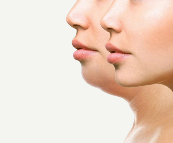 Por qué eliminar la papada